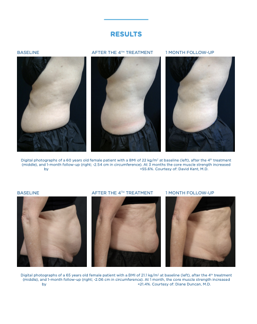 Abdominal before, after fourth treatment, and one-month follow-up photographs from a synchronized RF and HIFEM study
