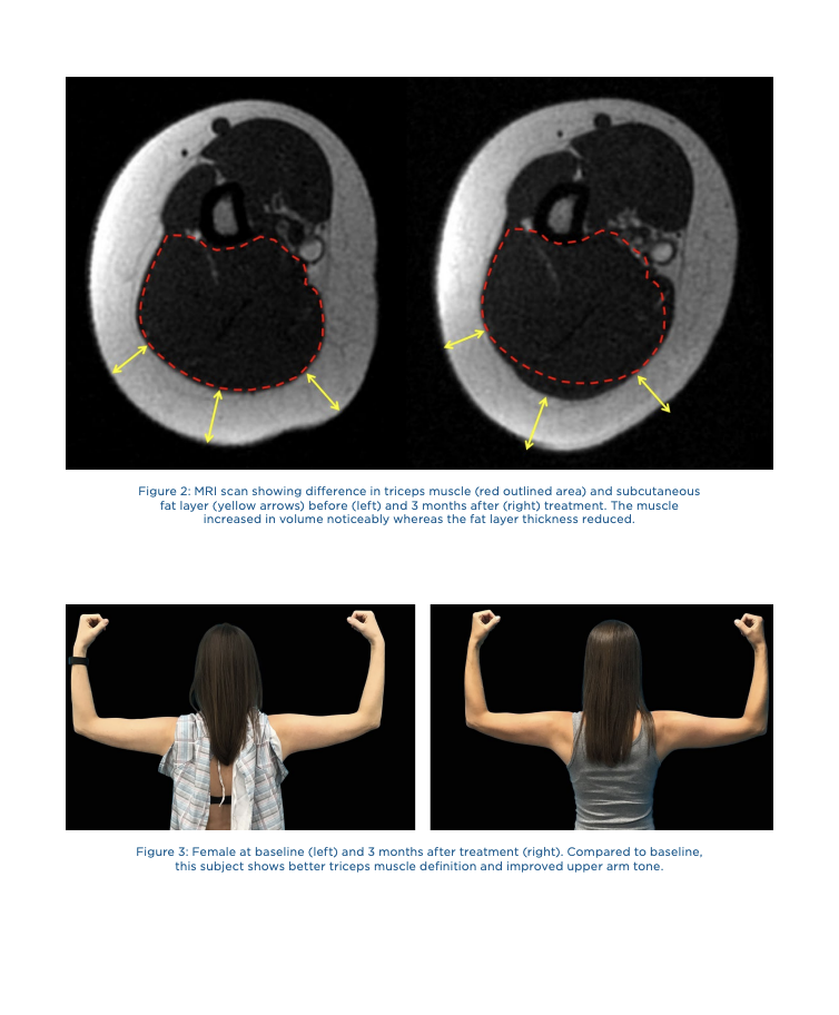 Triceps MRI scans and arm photographs before and three months after treatment