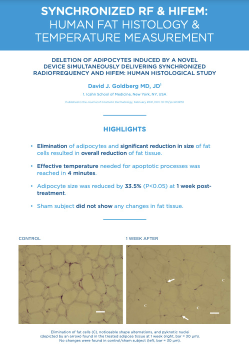 Histology study summary showing fat cell changes one week after synchronized RF and HIFEM treatment